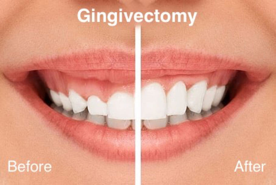 Gingivectomie